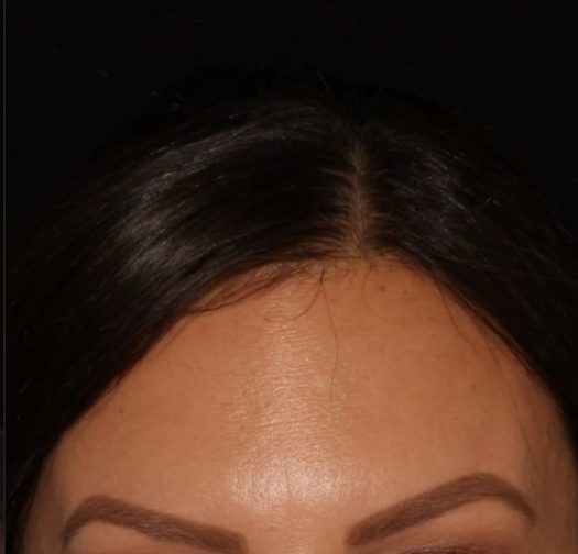 Close-up of a person's forehead, showing the hairline and groomed eyebrows, with a shadowy, plain dark background.