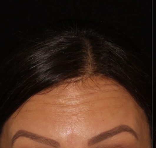 Close-up view of a person's forehead showing dark eyebrows, hairline, and smooth skin against a black background.