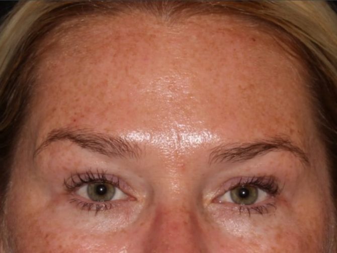 Close-up image of a woman’s face, focusing on her eyes and forehead. her skin displays freckles and she has light eyebrows and lashes.