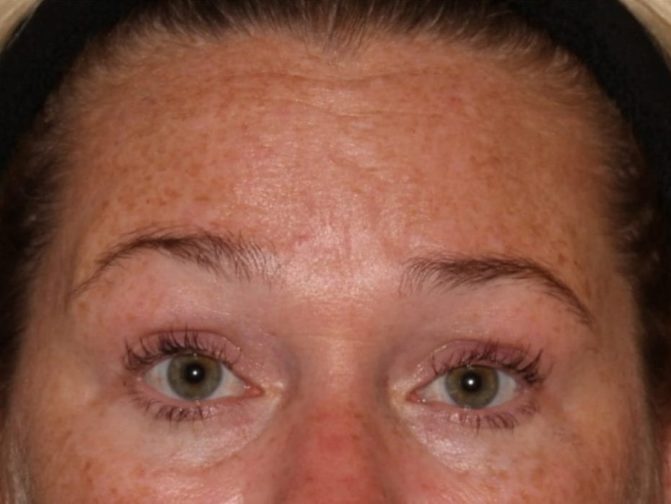 Close-up of a woman's face focusing on her eyes and forehead, showing freckles, light skin, and slight redness, with her eyebrows slightly raised.