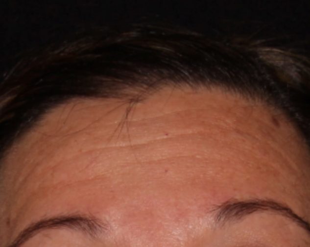 Close-up of a forehead showing signs of aging with visible wrinkles and a slight scar, framed by dark hairline, on a black background.