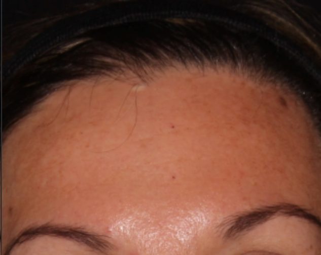 Close-up of a person's forehead showing clear skin with a few blemishes, partial eyebrows, and stray hairs under a hairband.