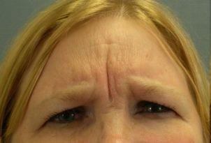 Close-up of a woman with light blonde hair furrowing her brows, showing noticeable worry lines on her forehead. her blue eyes look straight ahead with a focused expression.