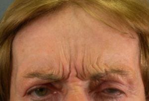 Close-up image of a person's forehead and eyes, showing deep furrowed brows and wrinkles, indicative of a frown or concentration.