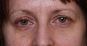 Close-up of a woman’s eyes showing signs of fatigue or sadness, with slight redness and bags under her eyes against a neutral background.