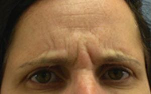 Close-up of a person's forehead and eyes, displaying a furrowed brow indicative of concern or deep thought, with visible wrinkles and dark eyebrows.