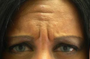 Close-up of a woman's eyes showing deep frown lines on her forehead, emphasizing signs of aging or stress.