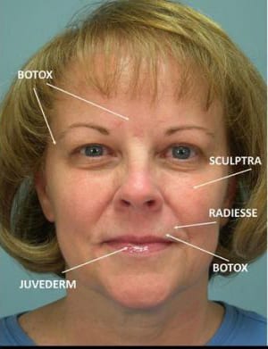 Frontal portrait of a woman with annotations indicating areas treated with cosmetic products like botox, sculptra, radiesse, and juvederm on her face.