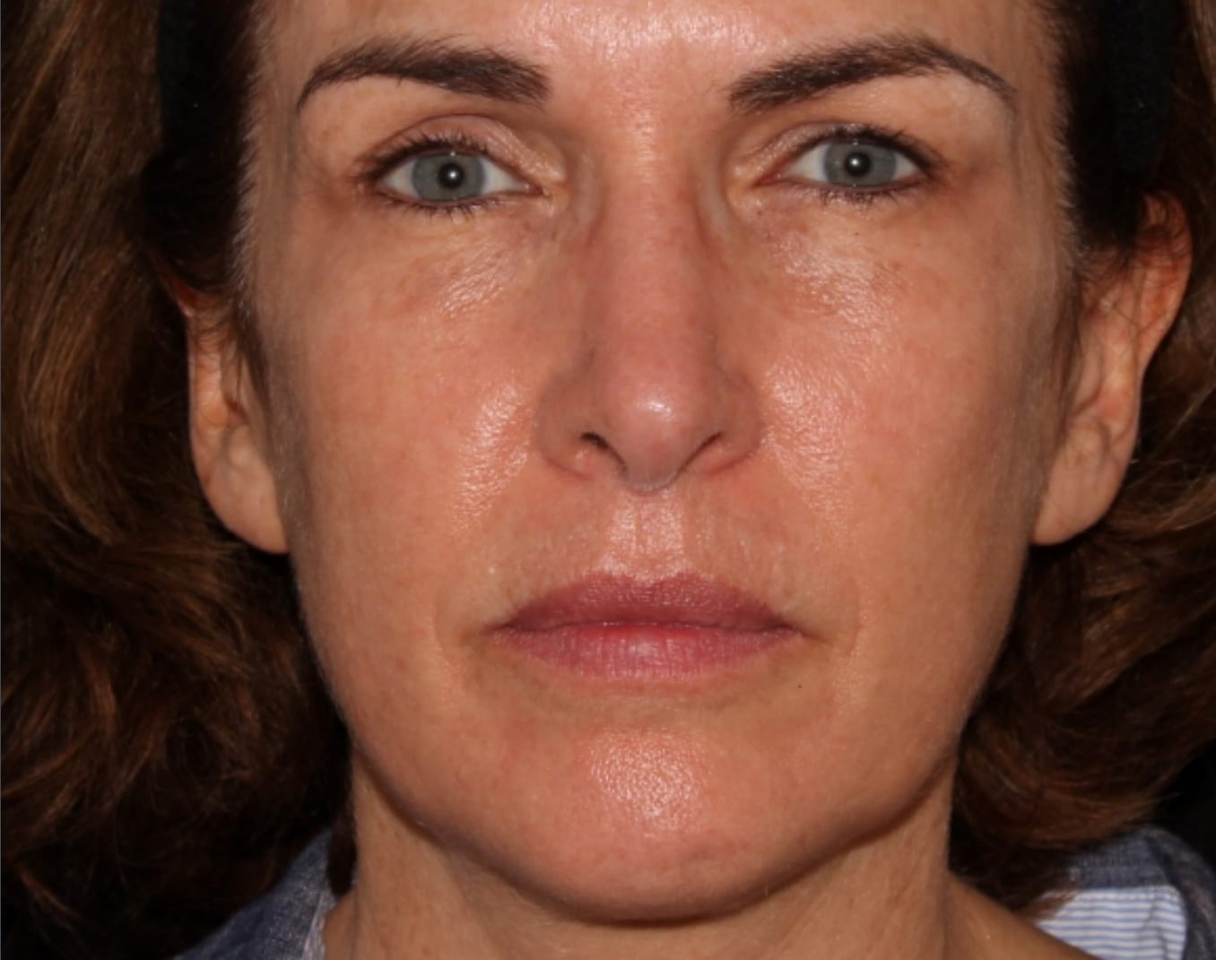Laser Treatment & Light Before & After Rejuva Center