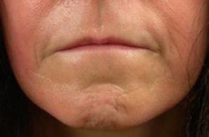 Close-up of the lower half of a person's face, showing details of lips and chin with visible signs of aging such as wrinkles and fine lines.