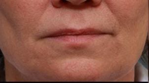 Close-up of a person's lower face, showing lips, chin, and part of cheeks with skin imperfections visible.