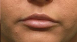 Close-up of a person's lips and lower nose, showing natural pink lips with a slight sheen and smooth skin texture.