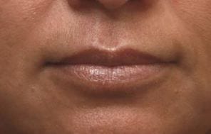 Close-up of a person's lips showing the lower part of the nose and the chin, emphasizing natural skin texture and lip gloss.