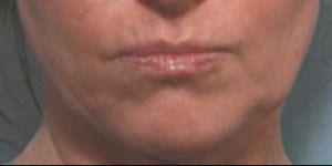 Close-up of a person's lips and chin showing a neutral expression. the image captures skin texture and subtle natural tones.