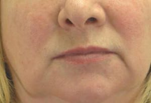 Close-up of the lower half of a woman's face showing nose, mouth, and chin, with visible pores and slight redness on cheeks.