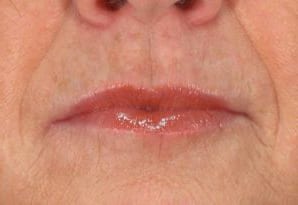 Close-up of a person's lips showing a glossy lip balm application. the skin is slightly textured and natural, highlighting subtle signs of aging around the mouth area.