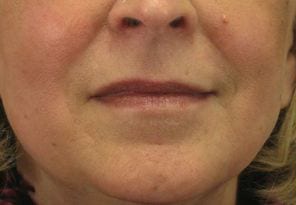 Close-up photo of the lower half of a woman's face, showing her nose, mouth, and chin with a neutral expression. her skin is fair with visible smile lines and a mole on the left side.