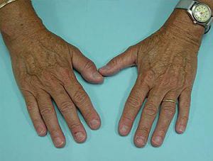 Two aged hands with visible signs of arthritis, particularly at the finger joints. the left hand wears a watch and a ring. resting on a light blue surface.