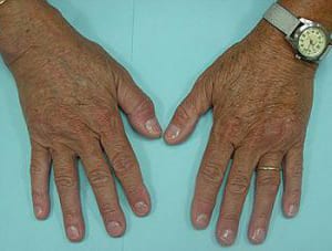 Two aged hands with visible veins and wrinkles resting on a light blue surface, featuring a wristwatch on the left hand and a simple ring on each ring finger.