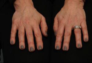 Two hands rest on a flat surface, palms down, displaying dirty fingernails. one hand wears a silver ring on the ring finger.