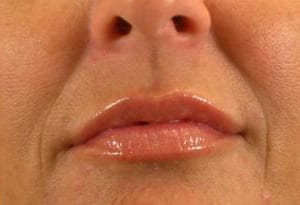 Close-up of a person's lower face, showing the nose and mouth with glossy lips, emphasizing detail in skin texture and lip shine.