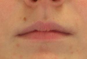 Close-up of a person's closed lips with a slight pink hue and a few facial blemishes visible on the surrounding skin.