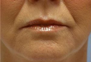 Close-up of a person's lips and part of their chin, showcasing a neutral expression and visible fine lines around the mouth area.