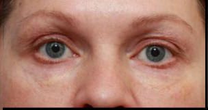 Close-up photo of a person's eyes, showing details of blue irises, light skin, and slight under-eye shadows. the image captures just the eye region, from eyebrow to cheek.