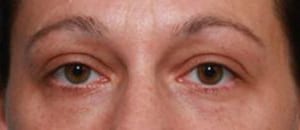 Close-up of a person's eyes showing signs of fatigue or aging, with slight redness and under-eye bags.