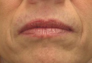 Close-up of a person's lips showing slight dryness and vertical lines, with a neutral expression. the skin around the lips has some natural aging signs.