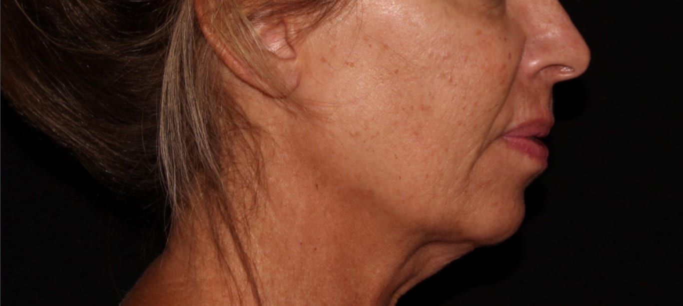 Side profile of a middle-aged woman with tan skin, visible age spots, and pulled-back hair, against a dark background.