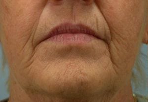 Close-up of an elderly woman's lower face, showing lips and chin with visible wrinkles and aging skin.