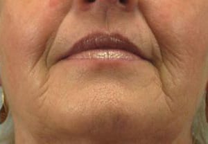 Close-up of a mature woman's lower face, showing lips with dark lipstick and visible smile lines, highlighting signs of aging skin.