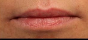 Close-up of a person's lips showing natural texture and slight redness, with a neutral expression.