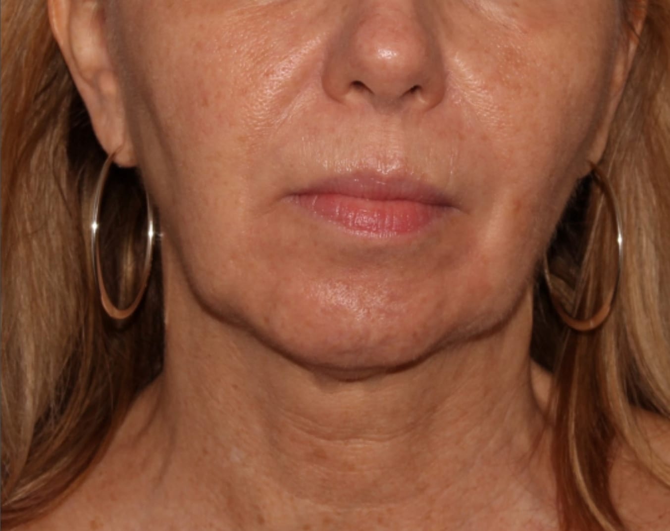 Close-up of a middle-aged woman's lower face, showing her nose, mouth, and chin, with visible signs of aging such as wrinkles. she wears hoop earrings.