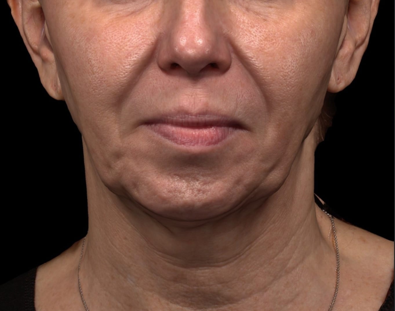 Dermal Fillers in Lower Face Before & After Photos Rejuva Center