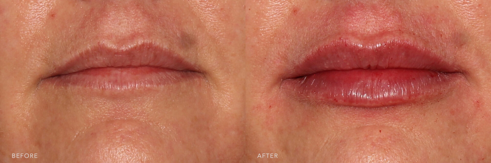 Close-up comparison of lips before and after treatment, showing reduced fine lines and enhanced lip hydration and fullness.