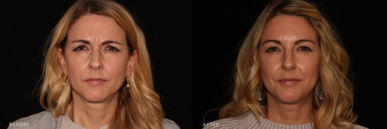 A photo of a woman's face before and after the Botox procedure. The before photo shows an expression that appears slightly more tense, with visible fine lines on her forehead, around the eyes, and nasolabial folds. Her skin has a more matte and slightly uneven texture. The after photo shows a softer and more relaxed expression. Her skin looks smoother, with reduced wrinkles, especially around the eyes and mouth, and a noticeable improvement in skin hydration, creating a natural glow. | Albany, Latham, Saratoga NY, Plastic Surgery