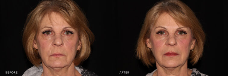 This a before and after image of a woman in her 60's, the image on the left show more lines in the forehead, marionette lines, nasolabial folds, lip lines, scar, lip lines, etc. The image on the right shows the same woman with her lines softened and her entire face appears to be lifted.