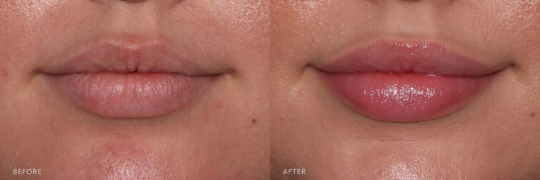 This is a before & after picture side by side, frontal view of lips only, showing natural lips on the left and plump lips on the right side.