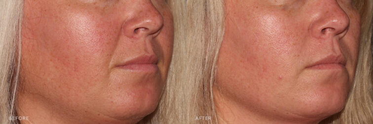 This is a side by side image of before and after treatment in the nasolabial folds. Before image shows deep lines around the month (laugh lines). In the after image the lines appear softened and volume is restored.