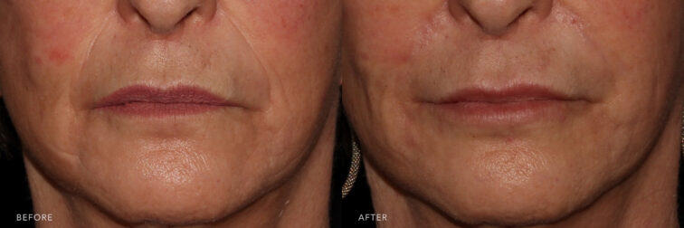 A before and after close-up view of a woman's lower face highlighting improvements in skin texture, reduction in redness on the cheeks, and Marionette Filler results.