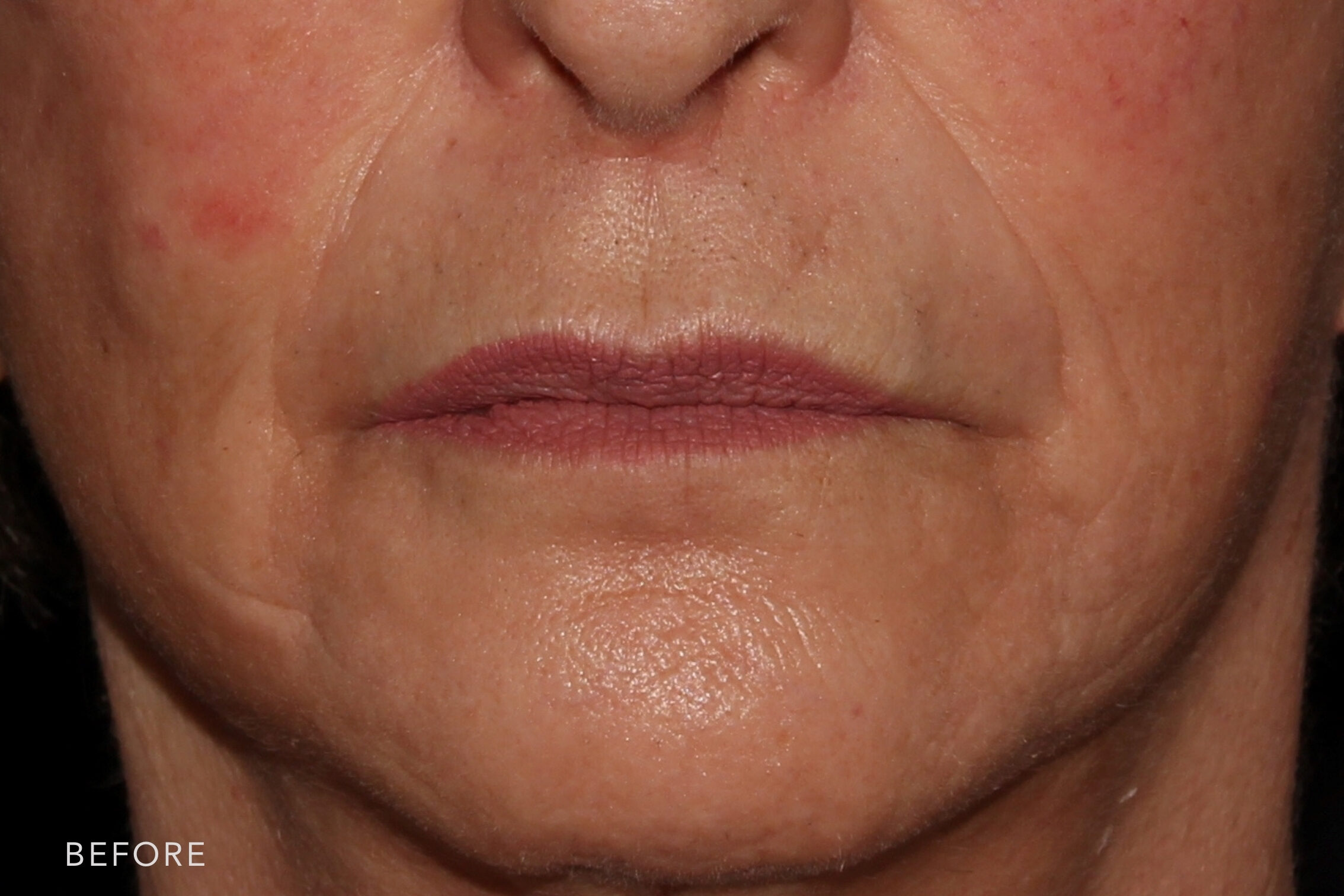 A before and after close-up view of a woman's lower face highlighting improvements in skin texture, reduction in redness on the cheeks, and Marionette Filler results.
