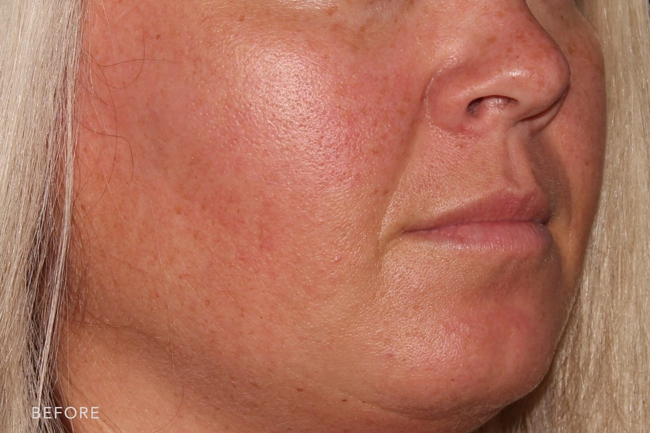 This is a side by side image of before and after treatment in the nasolabial folds. Before image shows deep lines around the month (laugh lines). In the after image the lines appear softened and volume is restored.