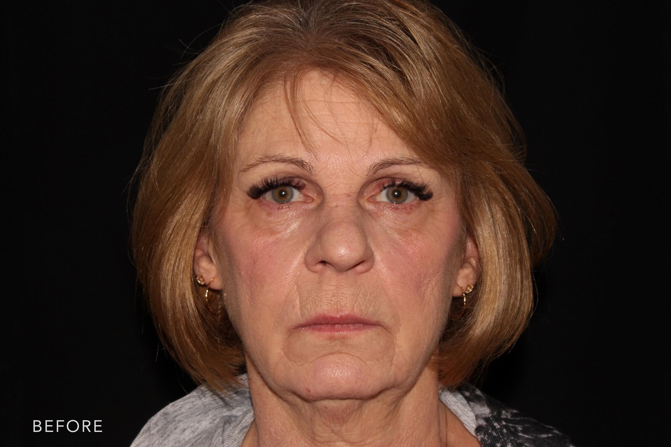 This a before and after image of a woman in her 60's, the image on the left show more lines in the forehead, marionette lines, nasolabial folds, lip lines, scar, lip lines, etc. The image on the right shows the same woman with her lines softened and her entire face appears to be lifted.