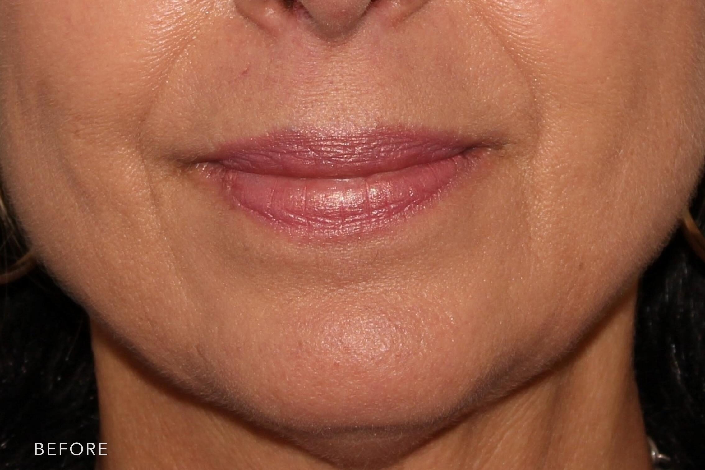 Before and after photo of a woman's mouth and jaw before and after filler. Filler was injected into her smile lines to lessen the appearance of deep folds. After filler these folds are softer looking and not as noticeable. | Albany, Latham, Saratoga NY, MedSpa