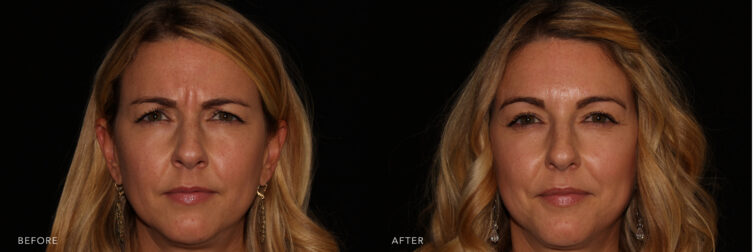 Before and after of a blonde middle aged woman's face taken from the front angle before and after botox. Before botox she had two deep wrinkles in the middle of her eyebrows. After botox those wrinkles are no longer present. | Albany, Latham, Saratoga NY, MedSpa