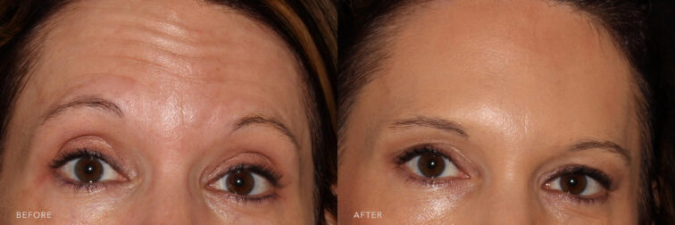 Before and after photo of a woman's face from the front angle taken from the eyes up. Before botox treatment she had visible wrinkles on her forehead when she would raise her eyebrows. After treatment those wrinkles have been softened and are no longer visible, leaving her with a smooth forehead. | Albany, Latham, Saratoga NY, MedSpa
