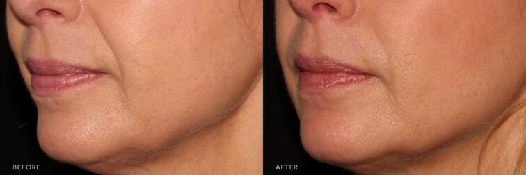 Before and after photo of a woman's mouth and jaw before and after filler. Filler was injected into her smile lines to lessen the appearance of deep folds. After filler these folds are softer looking and not as noticeable. | Albany, Latham, Saratoga NY, MedSpa