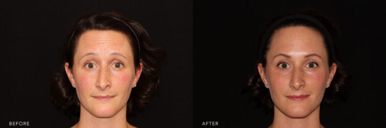 Side by side before and after of a woman's full face taken from the front angle pre and post botox treatment. Before botox her forehead had visible wrinkles, after treatment her forehead is smooth and wrinkle free. | Albany, Latham, Saratoga NY, MedSpa